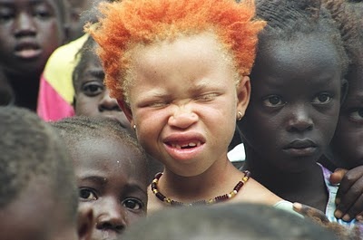Red Haired Albino